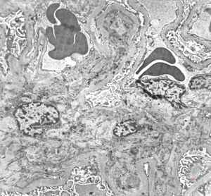 F,47y. | IgA nephropathy (Berger disease) F,47y. | IgA nephropathy (Berger disease)